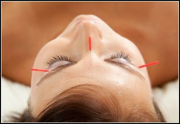 facial acupuncture